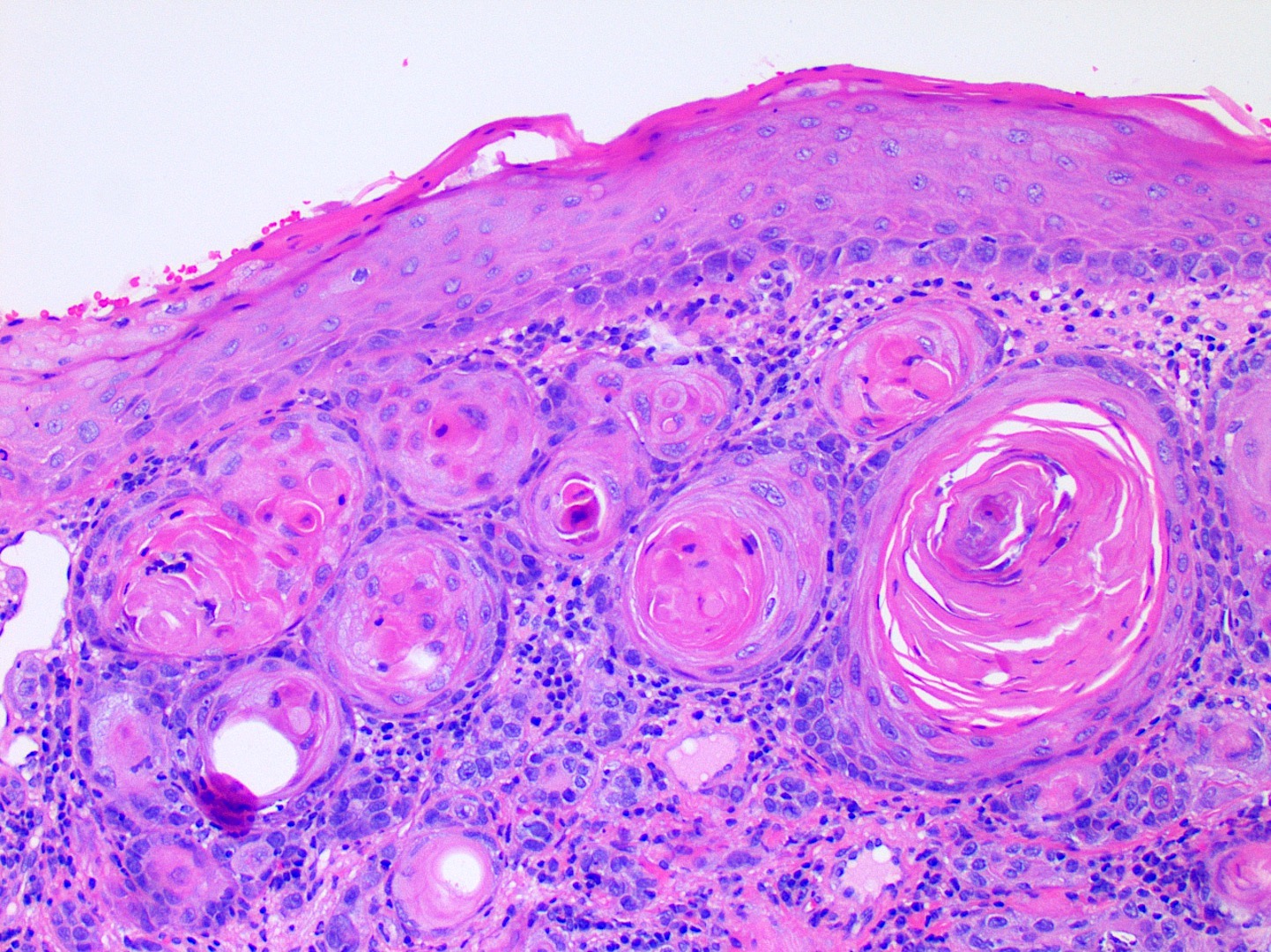 Squamous Cell Carcinoma Histology Labeled