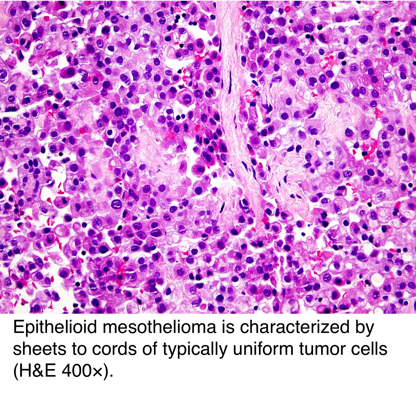 Mesothelioma Of Abdomen Icd 10