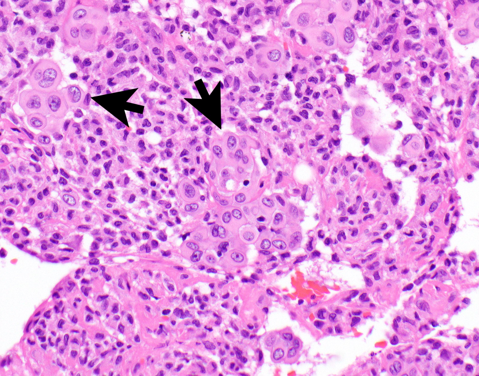 Mesothelioma Histology Psammoma