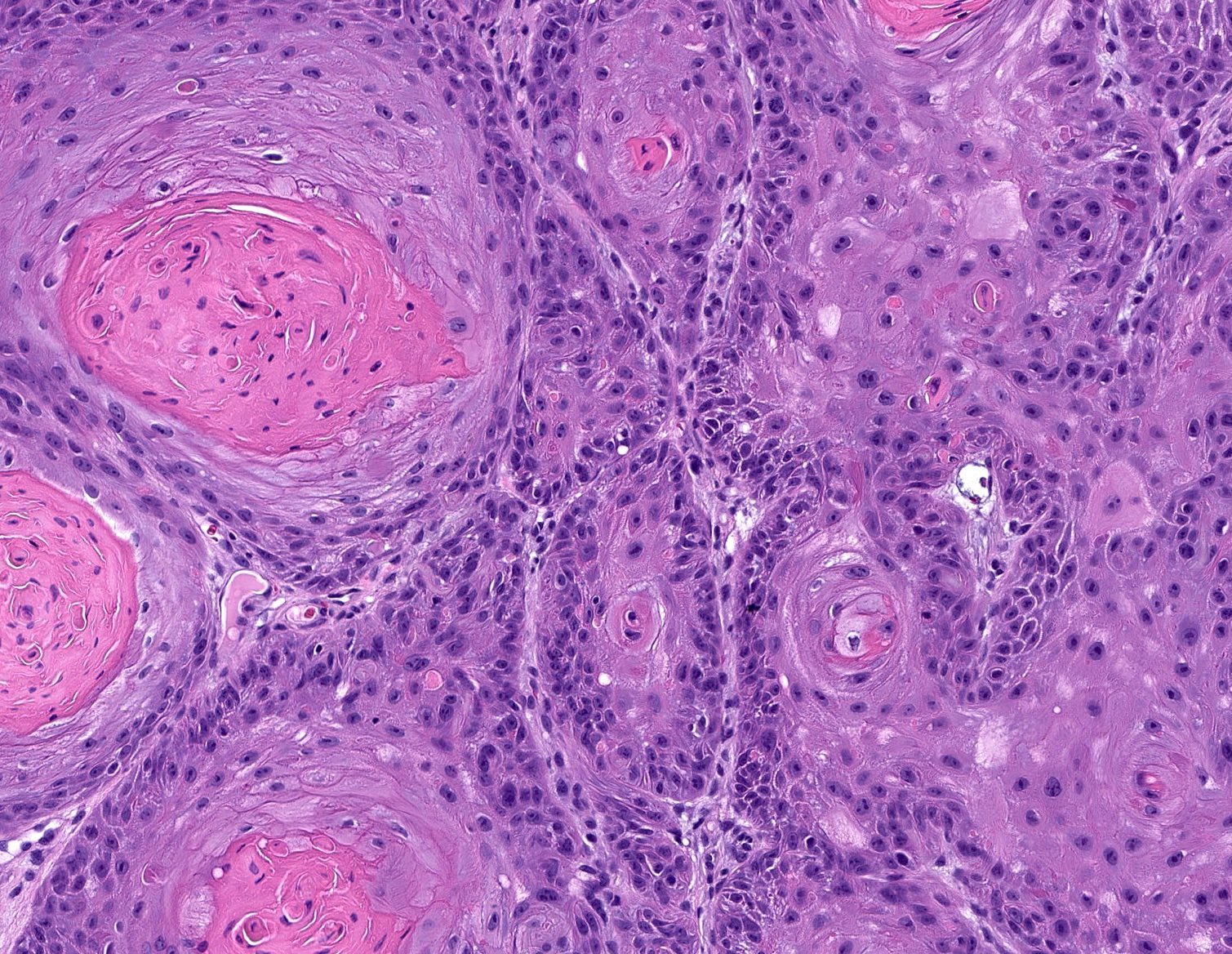 Squamous Cell Carcinoma Histology