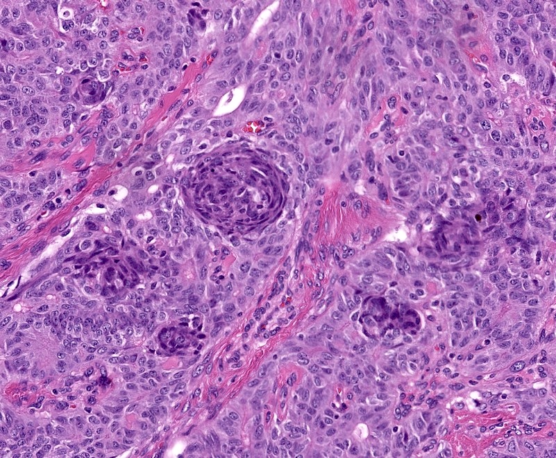 Pathology Outlines - Cribriform-morular thyroid carcinoma