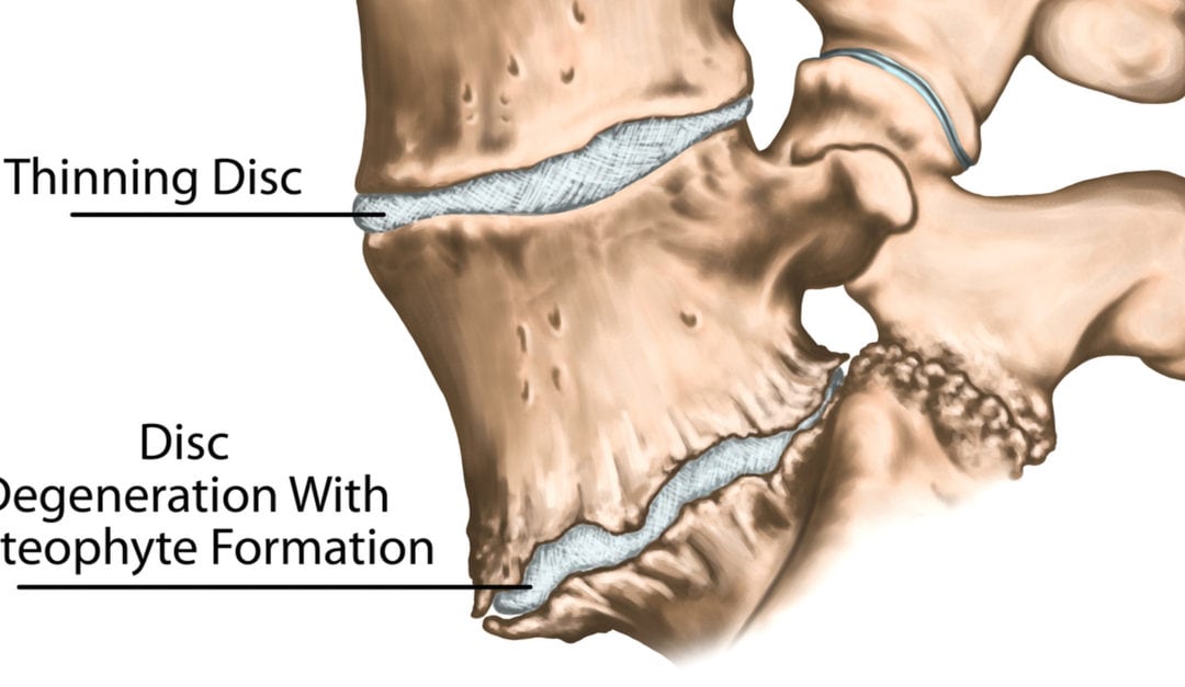 spine osteophytes