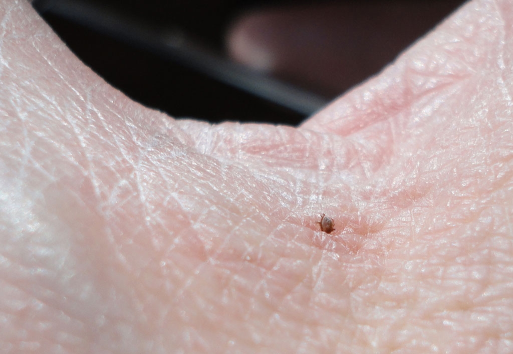 Tick Head In Skin