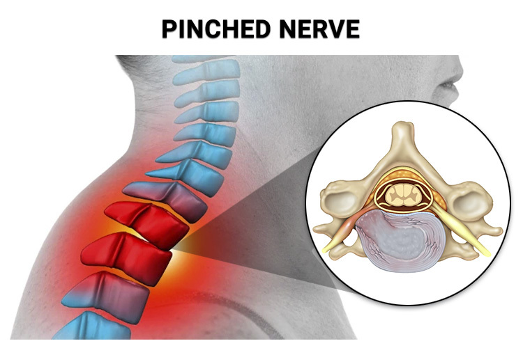 8 Top Warning Signs You Have a Pinched Nerve - Physical Therapists NYC