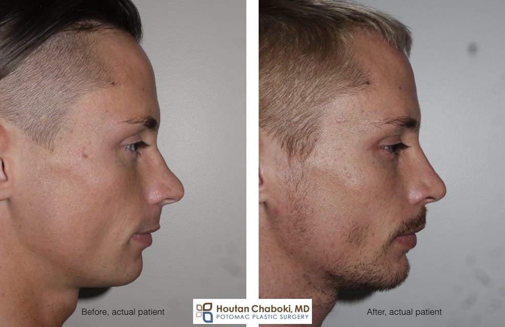 Blog post - before after radix graft rhinoplasty improve profile