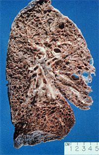 Epidemiology and Natural Course of IPF