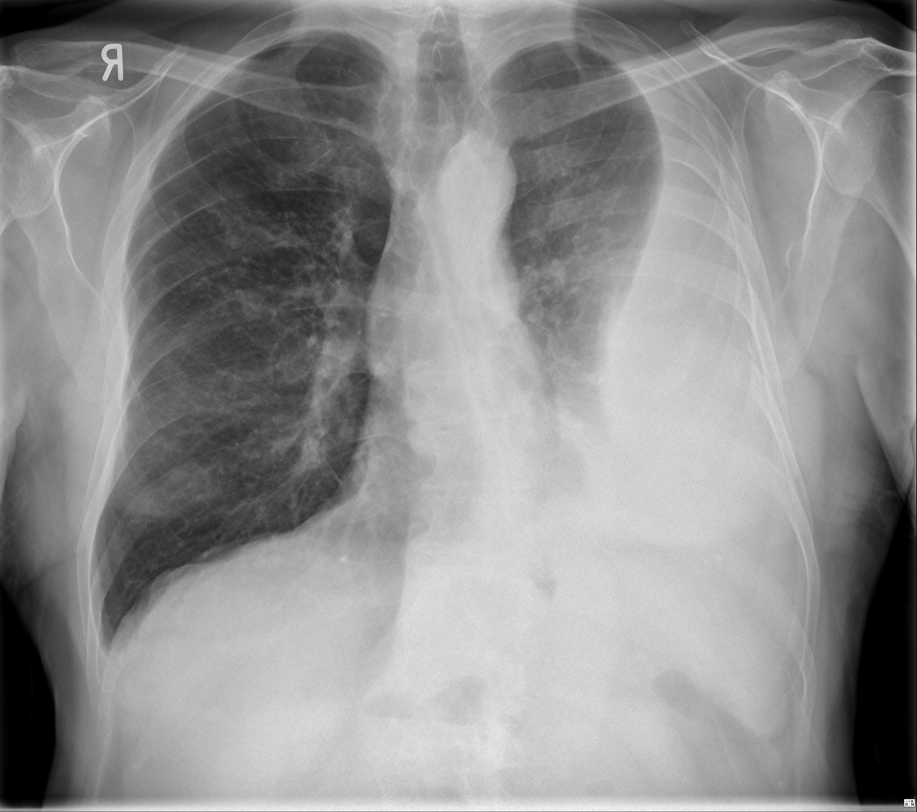 Loculated Pleural Effusion : Pleural Effusion Pulmonary Disorders Merck ...