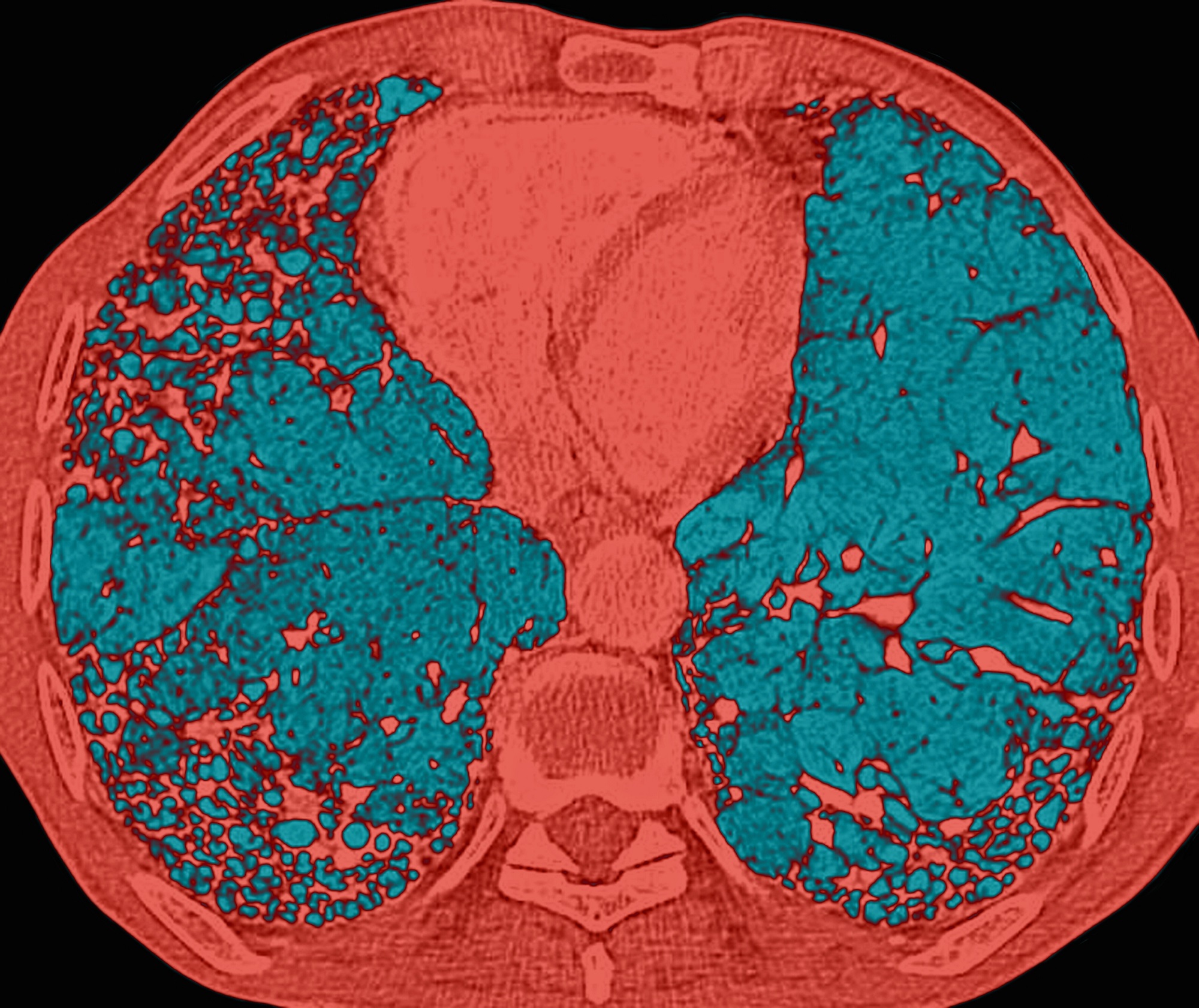 Idiopathic Pulmonary Fibrosis Honeycomb