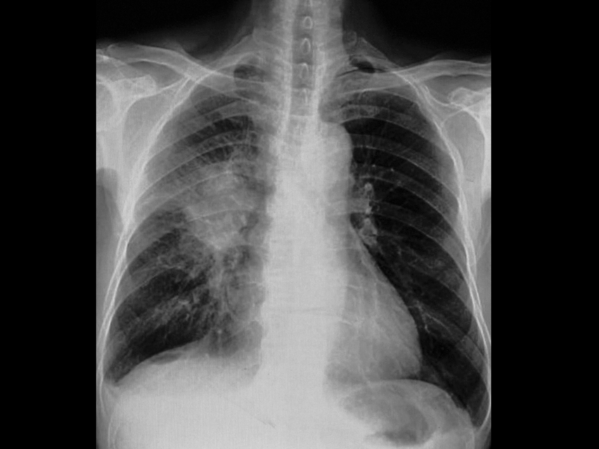 lung cancer x ray vs pneumonia x ray Mri vs x-ray