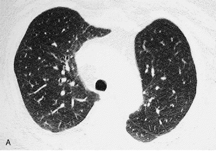 High-resolution CT of peripheral airways diseases - Radiologic Clinics