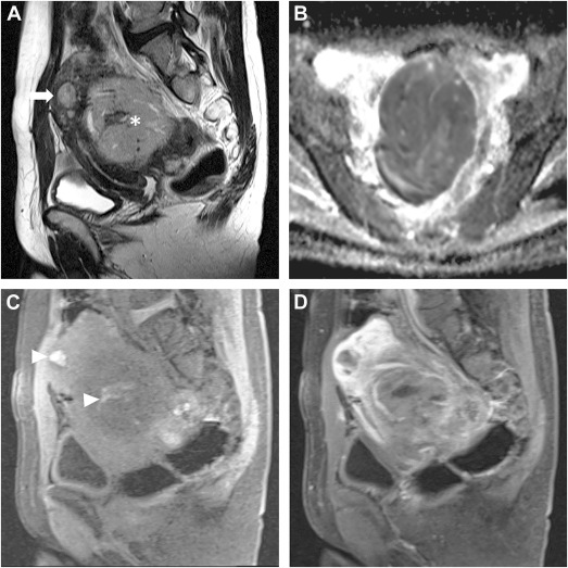 Current Concepts in the Imaging of Uterine Sarcomas - Radiologic Clinics