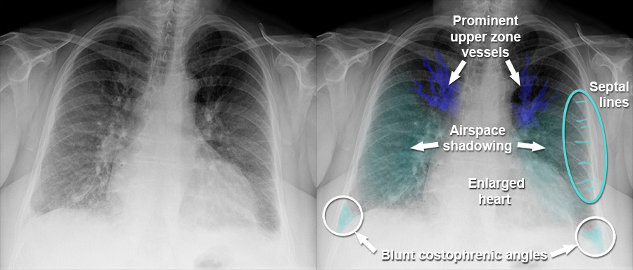 Chest X-ray - Cardiac disease - Upper zone vascular prominence