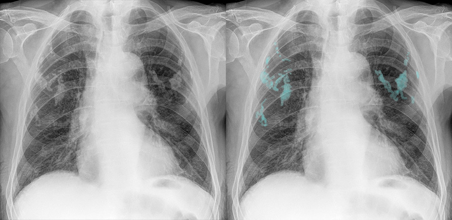 Chest X Ray Cardiac Disease Pleural Effusions - vrogue.co