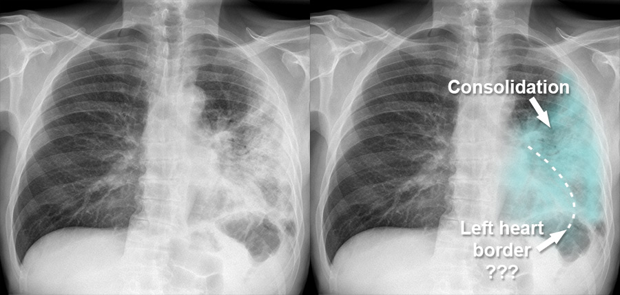 Chest X-ray - Pulmonary disease - Atypical pneumonia