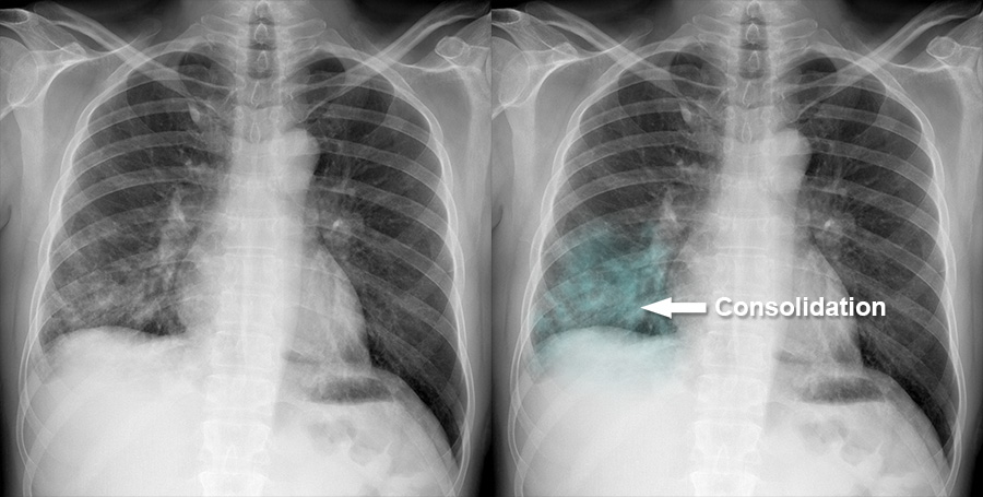 Chest X-ray - Pulmonary disease - Consolidation - Zonal