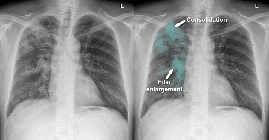 Chest X-ray - Pulmonary disease - Tuberculosis