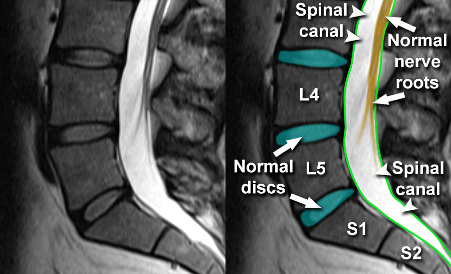 Lumbar Spine Mri Bulging Disc