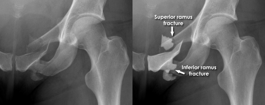 Trauma X-ray - Axial skeleton gallery 2 - Pelvis - Pubic ramus fractures