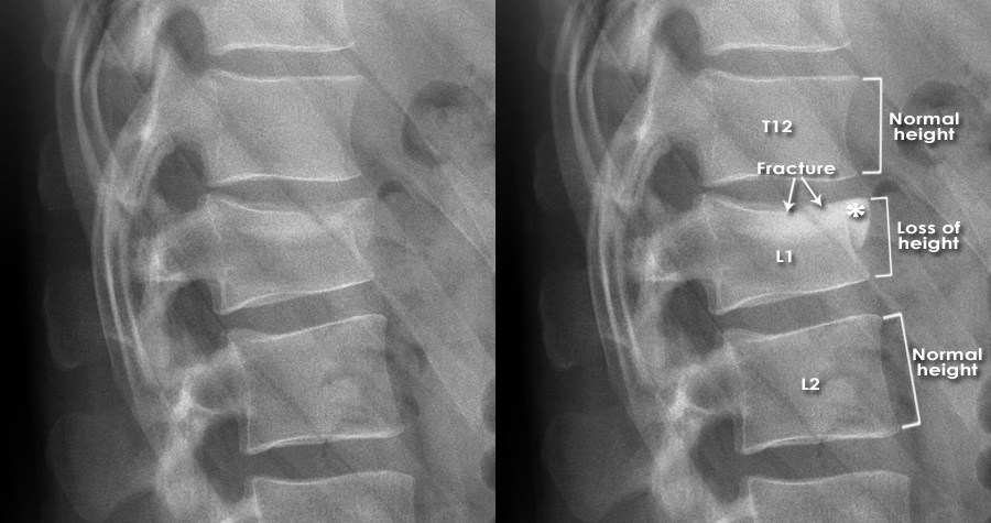 Compression Fracture