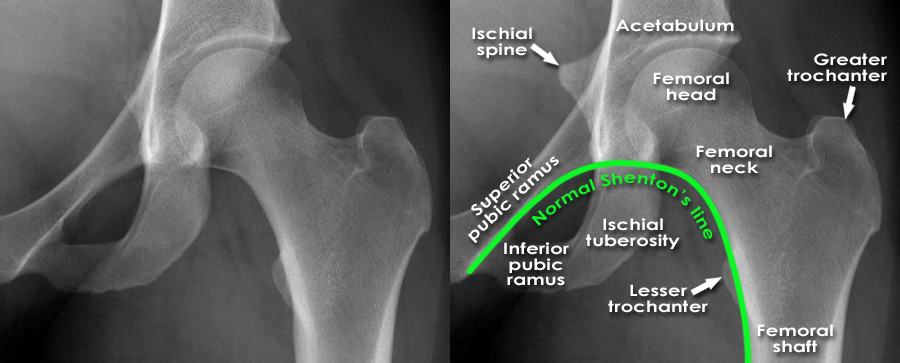 Intertrochanteric Fracture Vs Femoral Neck Fracture image.