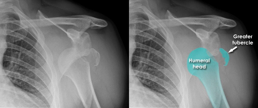 Acromioclavicular Joint Dislocation X Ray