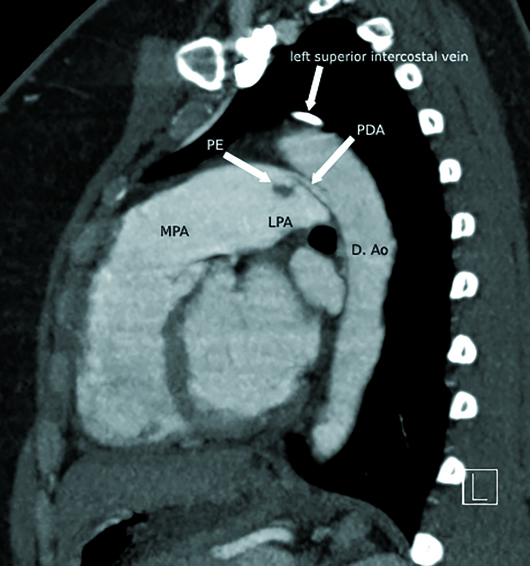 Patent Ductus Arteriosus X Ray