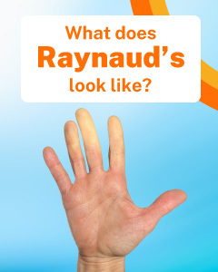 What Does Raynaud's Disease Look Like?