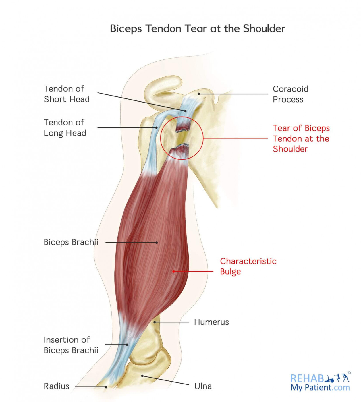 Biceps Tendon Tear at the Shoulder | Rehab My Patient