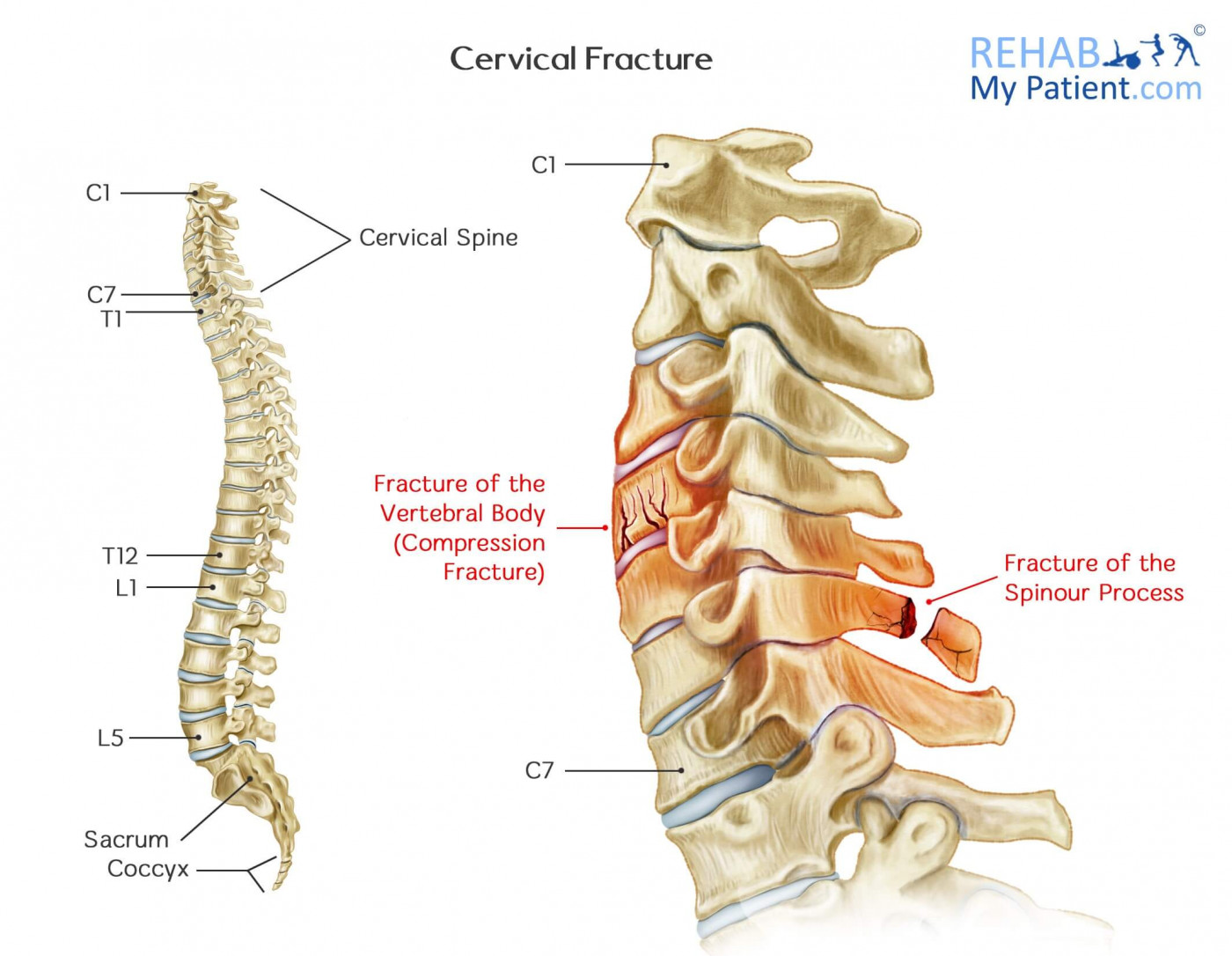 Cervical Fracture | Rehab My Patient