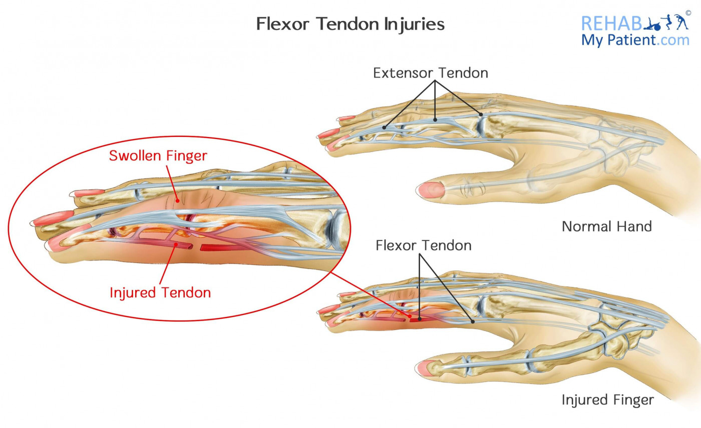 Late Reconstruction Of Flexor And Extensor Tendon Injuries | My XXX Hot ...