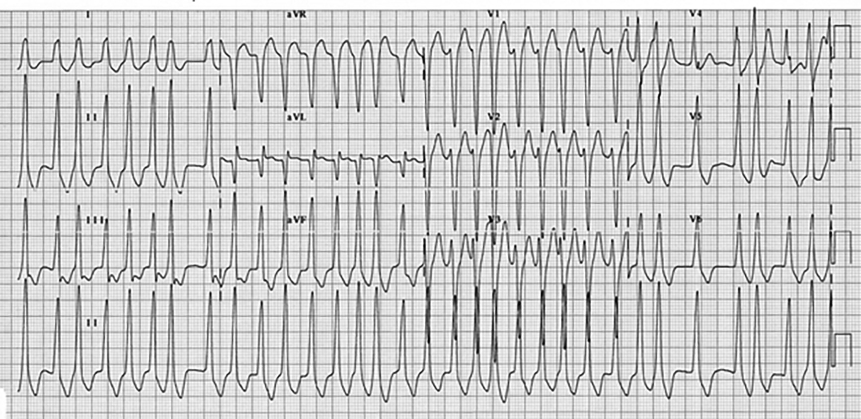 Afib With Rvr Treatment