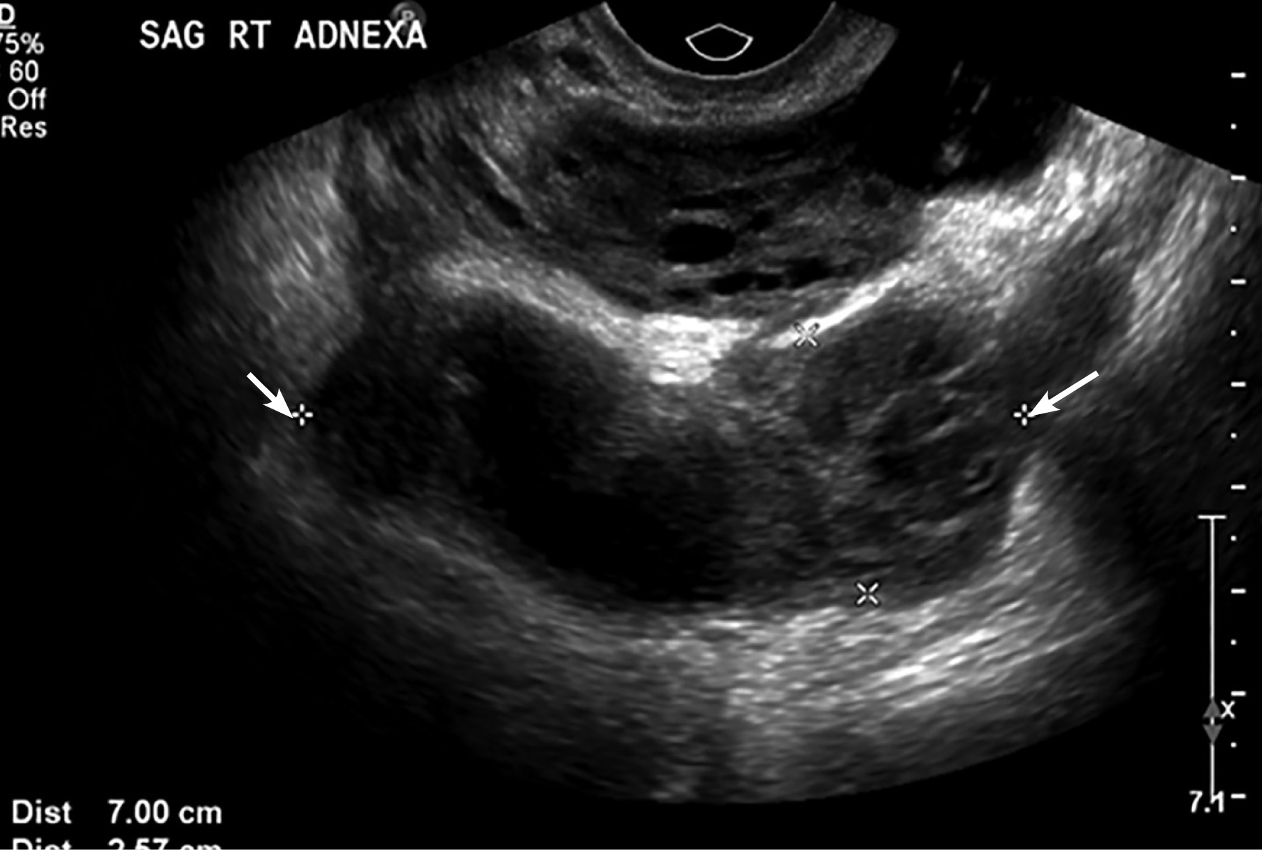 Pelvic Inflammatory Disease Ultrasound