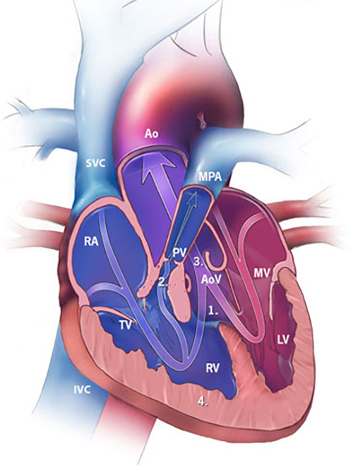 Diagnosis and Management of Infants With Critical Congenital Heart…