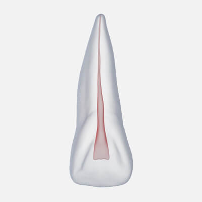 Human Upper Left Central Incisor Tooth With Pulp Cavity