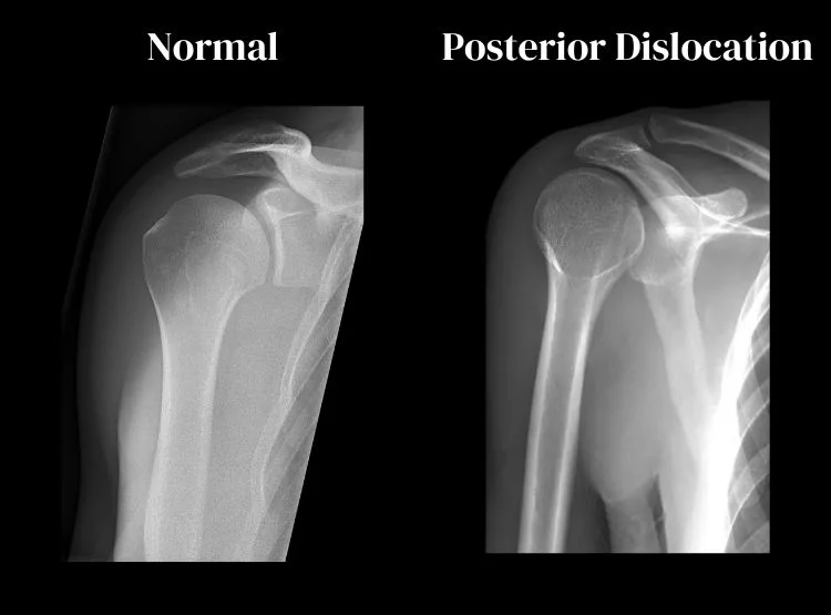 Broken Shoulder X Ray