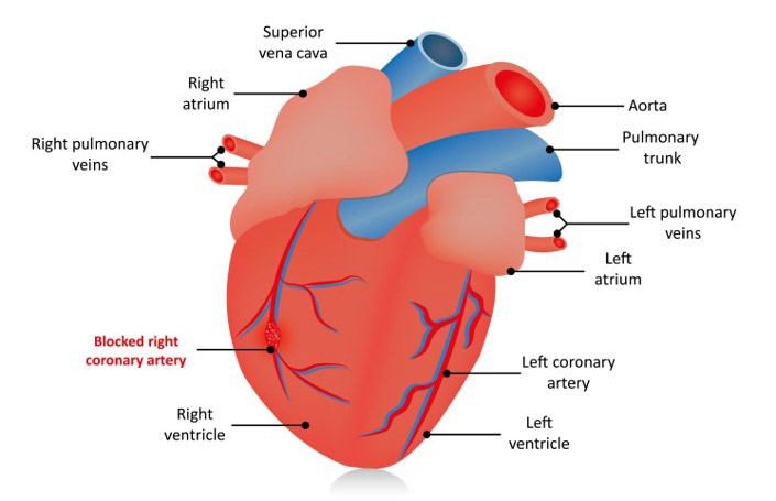 PCI & Coronary Artery Disease Treatment | REVA