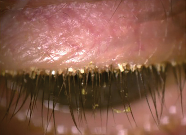 A Stepwise Approach to Diagnosing Dry Eye Disease