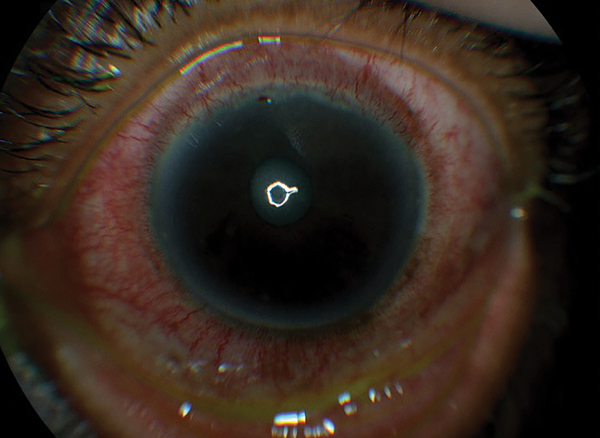 Distinguishing Episcleritis from Scleritis in Optometric Practice