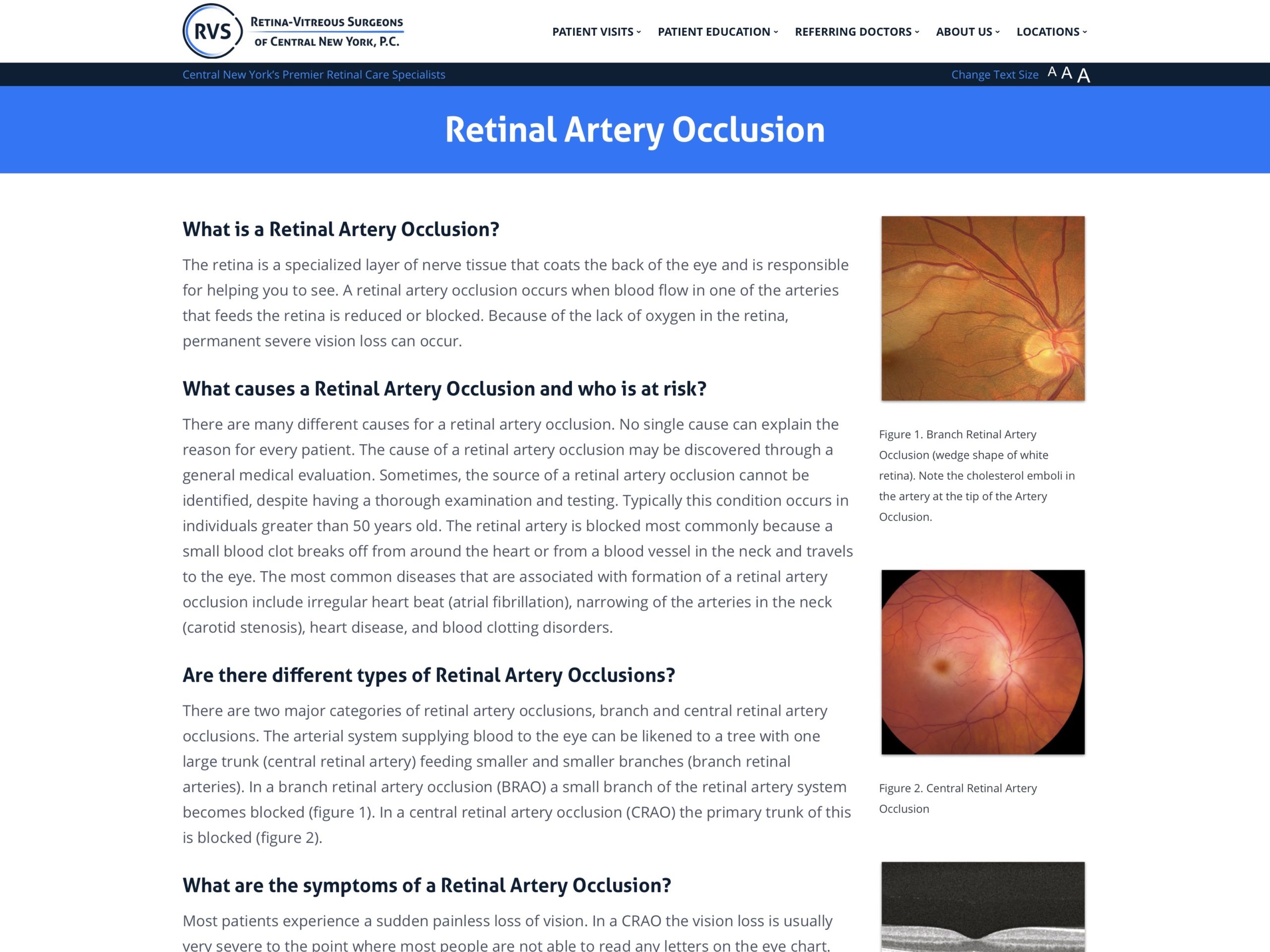 Central Retinal Artery Occlusion Anatomy