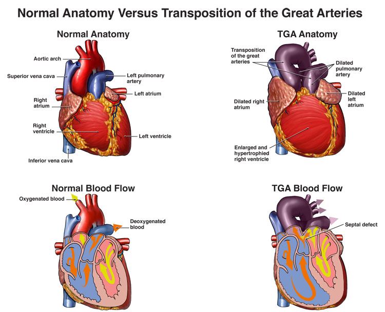 Transposition Of The Great Arteries Coronary Artery Anatomy