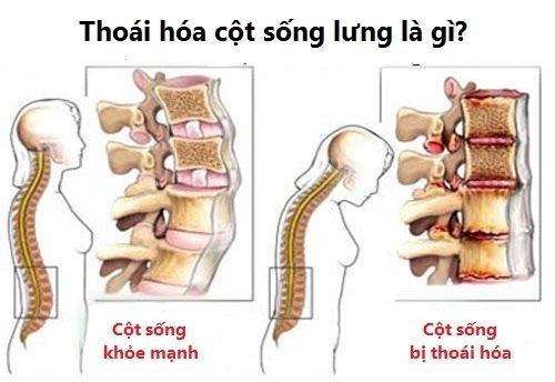 Thoái Hóa Cột Sống Có Nên Tập Yoga Bay 10