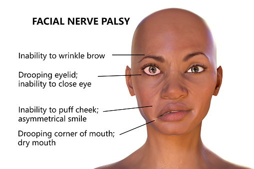 Facial Nerve Palsy