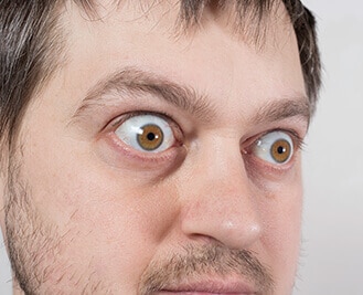 Man with bulging eyes due to thyroid disease