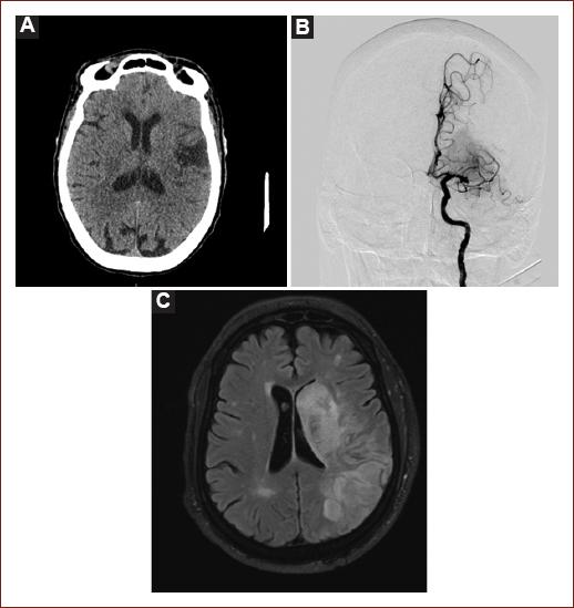 Stroke and atrial fibrillation: An update