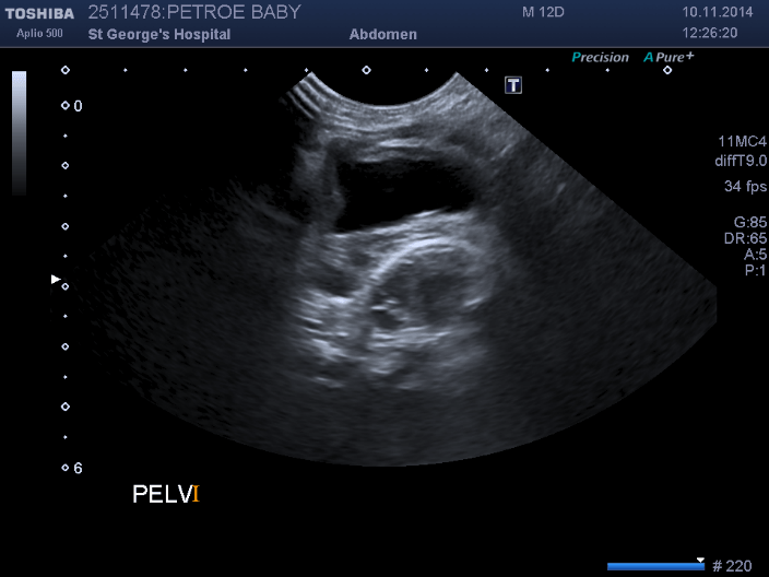 A case of Zinner?s syndrome (seminal vesicle cyst with ipsilateral ...