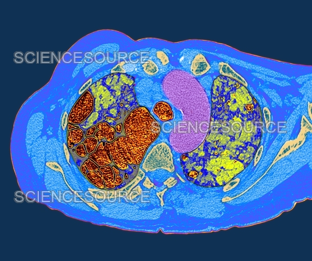 Lung fibrosis, CT scan | Stock Image - Science Source Images