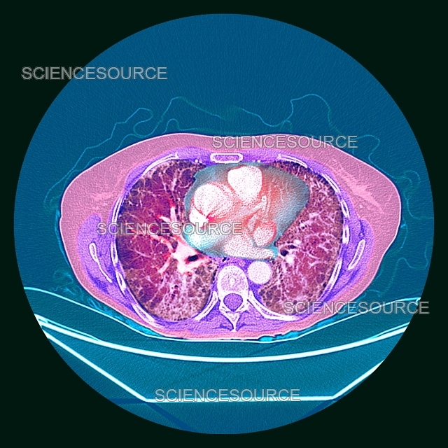 Pulmonary fibrosis, coloured CT scan | Stock Image - Science Source Images