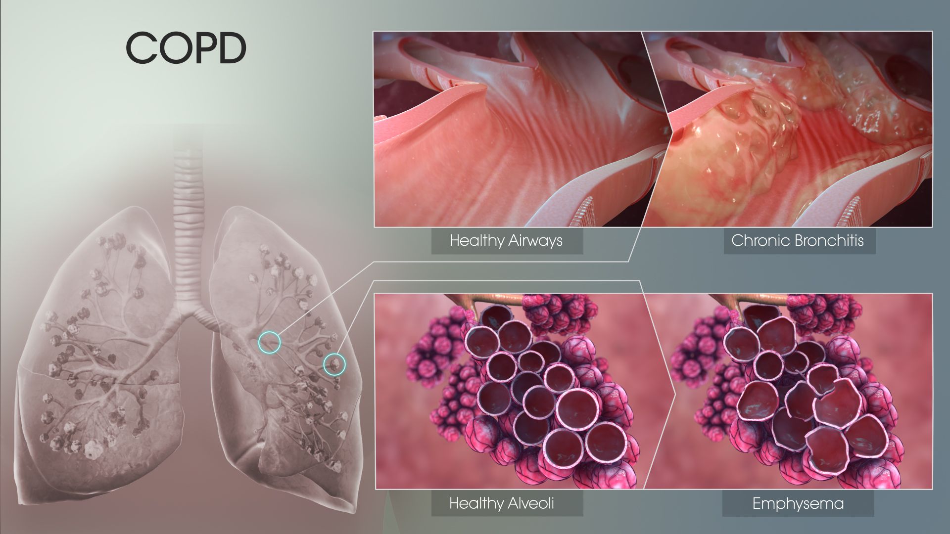 How Does Copd Affect The Body Systems - PELAJARAN