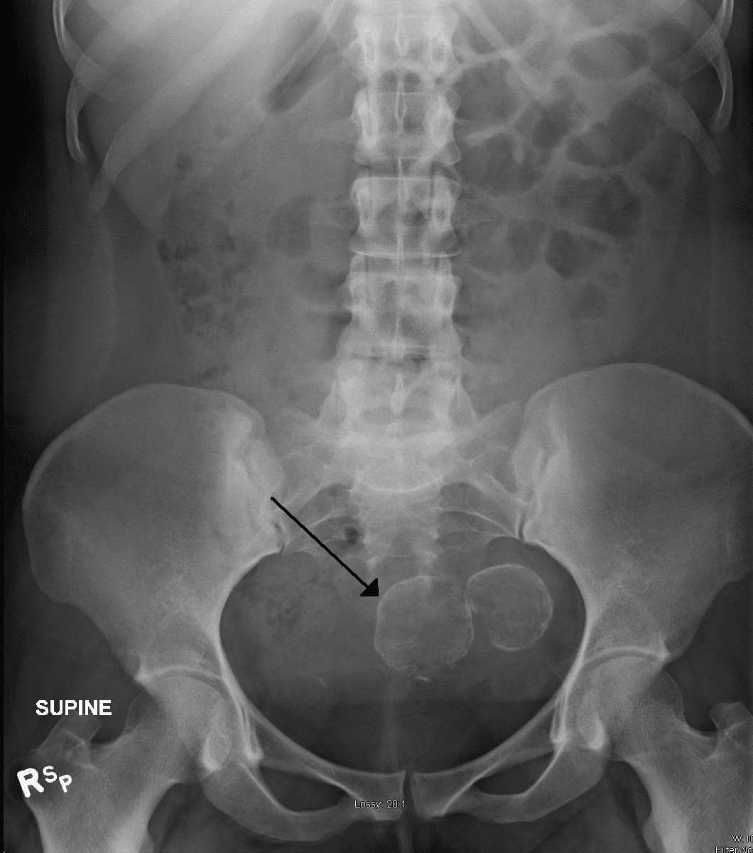 Uterine Fibroids Xray