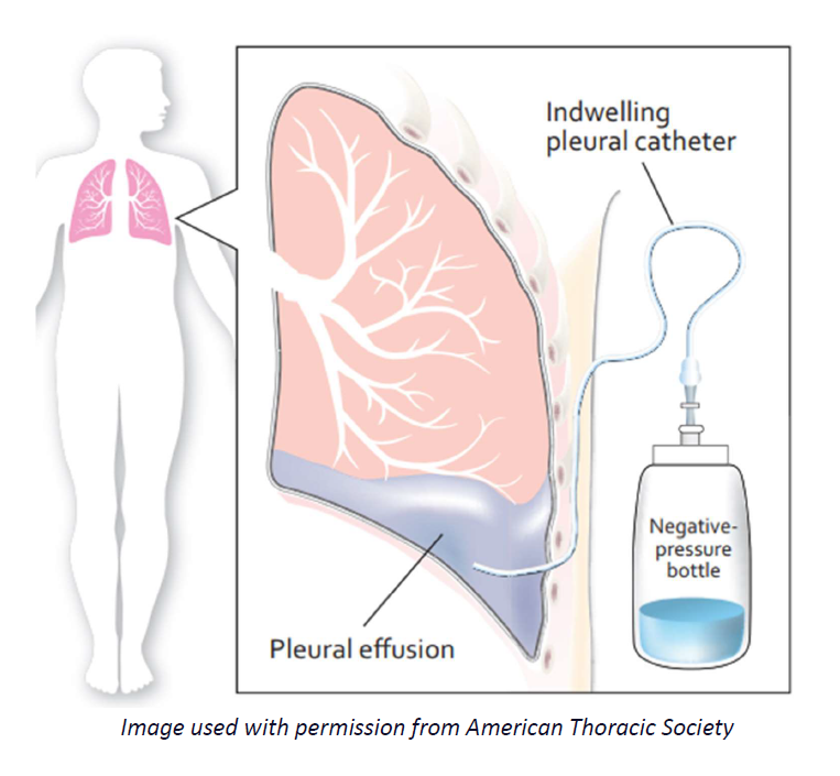 Guide to Indwelling Pleural Catheter